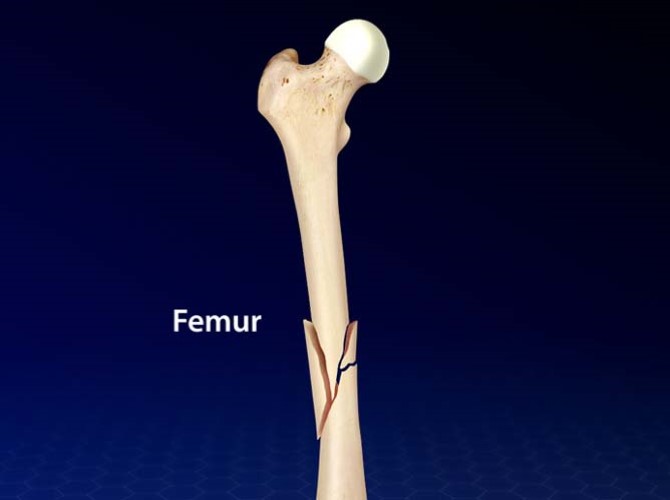 Femur Fracture
